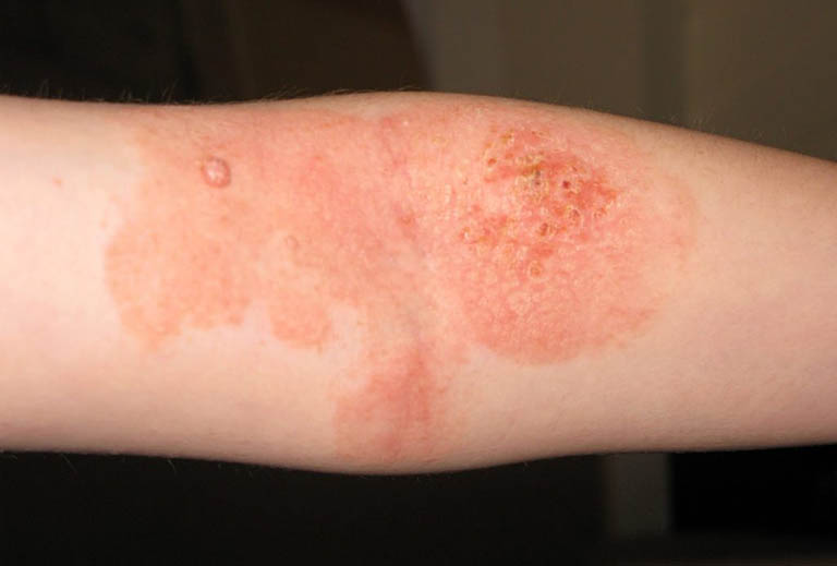 Bệnh chàm Eczema là gì