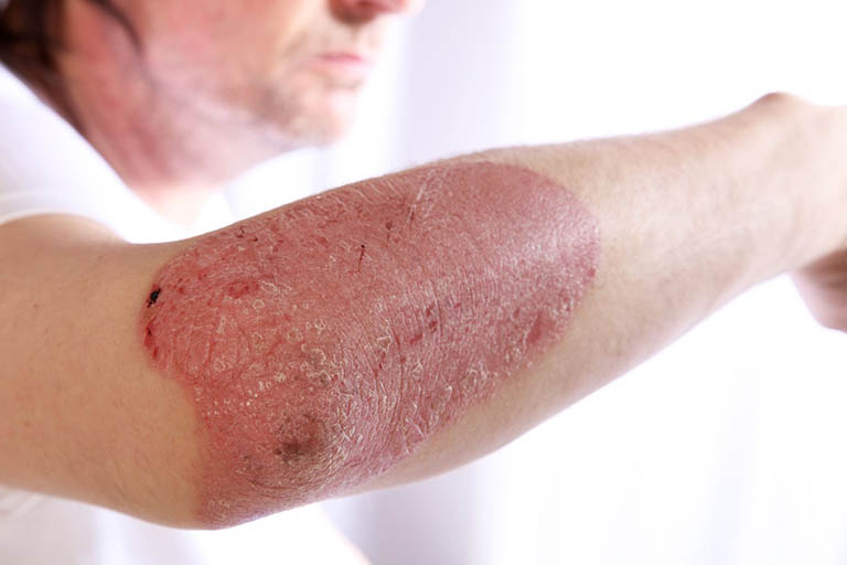 Chàm - Eczema là bệnh gì? Nguyên nhân và giải pháp điều trị