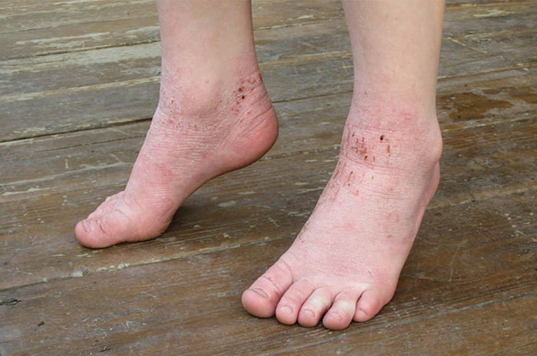 Triệu chứng của bệnh tổ đỉa xuất hiện ở chân