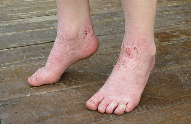 Triệu chứng của bệnh tổ đỉa ở chân