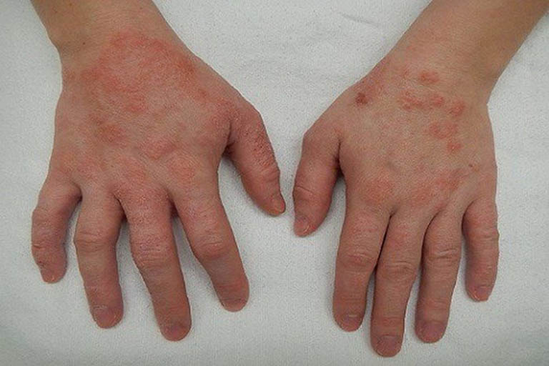 Da tay có dấu hiệu khô ráp nghiêm trọng, da bong tróc và đỏ ửng