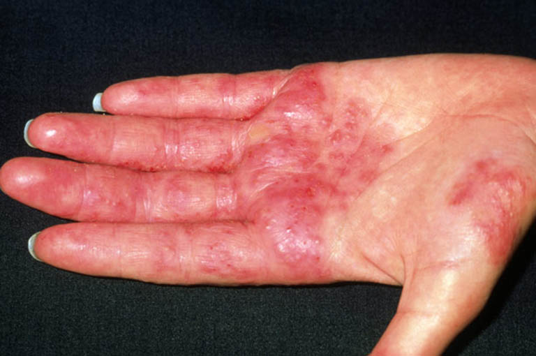 Triệu chứng của bệnh viêm da cơ địa ở tay