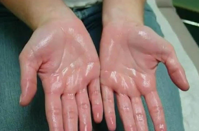 Bệnh viêm da cơ địa xuất hiện ở ngón tay
