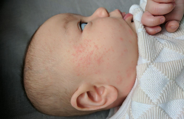 eczema ở trẻ sơ sinh
