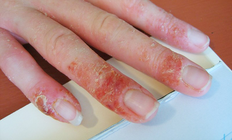 chàm khô ở đầu ngón tay là bệnh gì