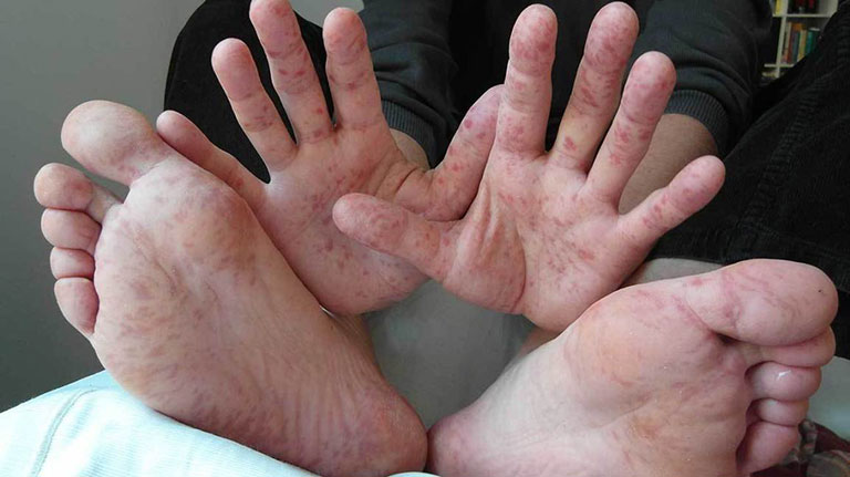 bị nổi mẩn đỏ ngứa ở tay chân là bệnh gì