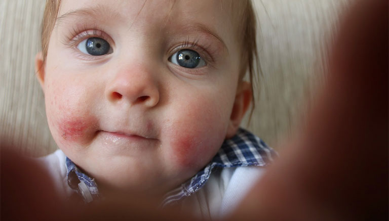 bệnh viêm da cơ địa ở trẻ em