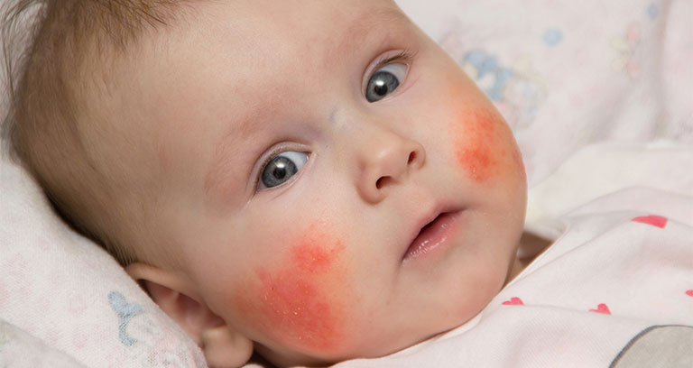 viêm da ở trẻ sơ sinh có nguy hiểm không