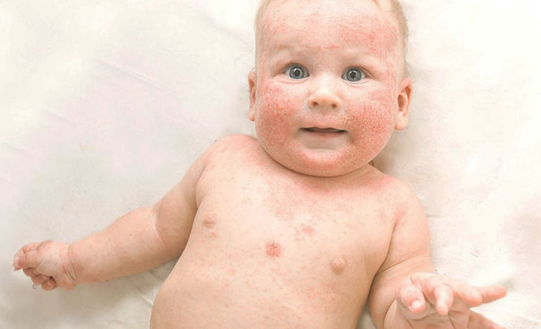 bệnh chàm khô ở trẻ em