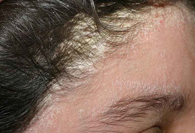 Vảy nến da đầu khiến làn da trông mất thẩm mỹ và tác động tiêu cực đến tâm lý người bệnh