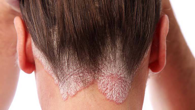 Vảy nến gây ra các mảng da bong tróc và dày sừng tại vùng da bị tổn thương