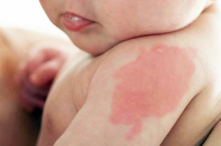 Chàm đỏ là một thể chàm eczema nhưng lành tính, không gây nguy hiểm đến sức khỏe