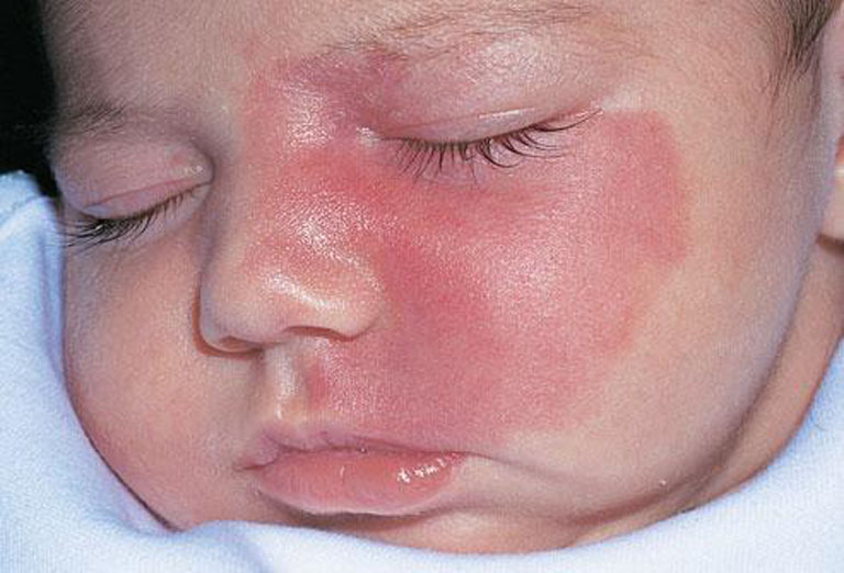 Bệnh chàm đỏ phát triển ở vùng da mặt của trẻ gây mất thẩm mỹ