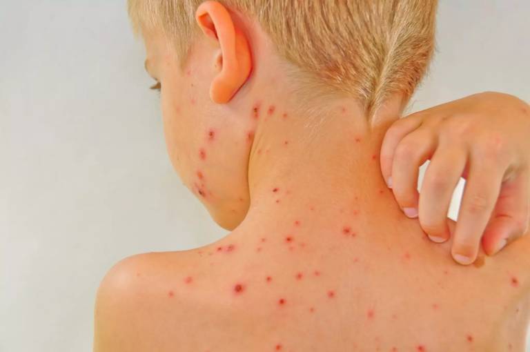 Lupus ban đỏ gây nổi nốt đỏ trên da như muỗi đốt không ngứa