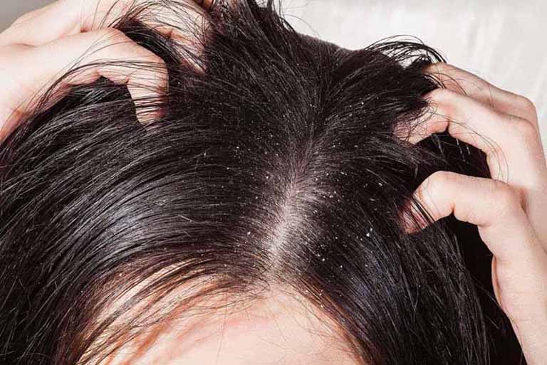 Các tác động cơ học gây tổn thương da đầu cũng là nguyên nhân gây ra bệnh