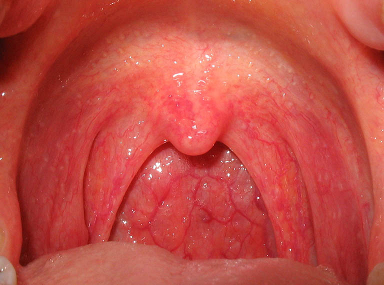 Niêm mạc họng sưng đỏ, có chất nhầy trong suốt là triệu chứng thường gặp của bệnh viêm họng ở giai đoạn mãn tính