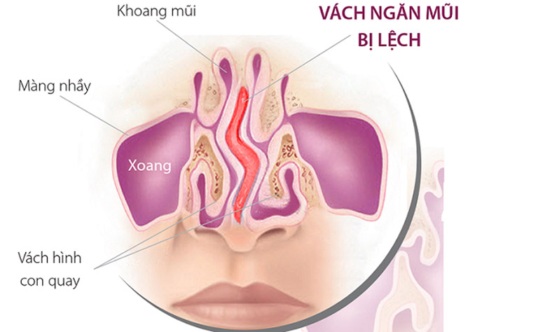 Viêm xoang cấp do lệch vách ngăn mũi nếu không được xử lý đúng sẽ có nguy cơ chuyển biến sang mãn tính